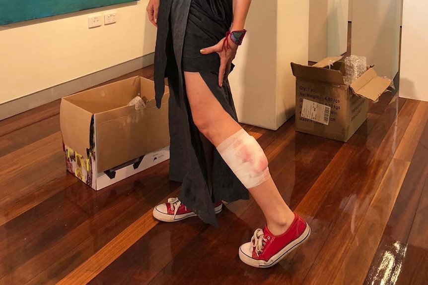 Tanja Stark shows her bandaged leg where she had a melanoma removed on the same morning of January 30, 2018.