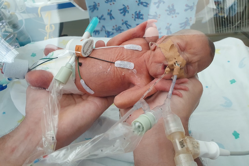 A pair of hands hold a tiny premature baby in the hospital.