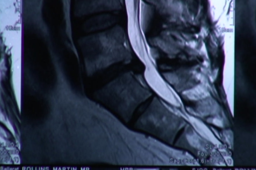 An x-ray of Martin Rollins' spine