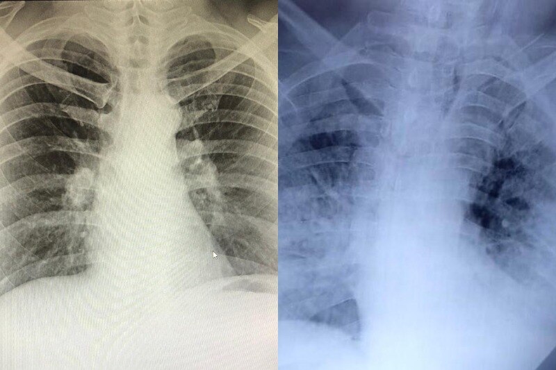An x-ray of two lungs with bones and black space.
