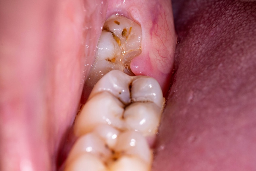 Partially-erupted wisdom tooth