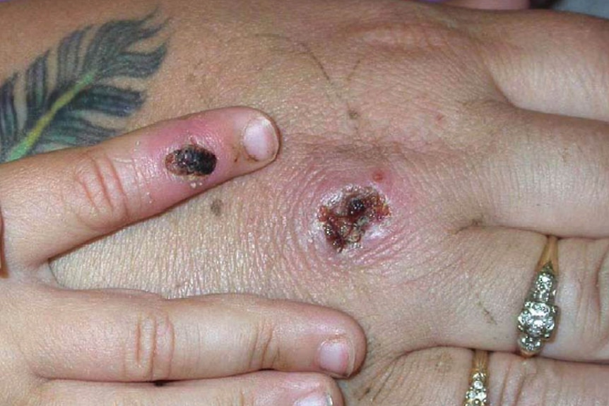 Large scabs are seen on a person's finger and the back of their hand