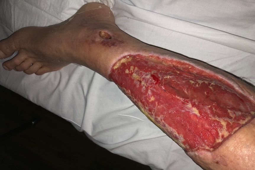 A photo of a left leg without any tissue left in the shin area following a bacterial infection.