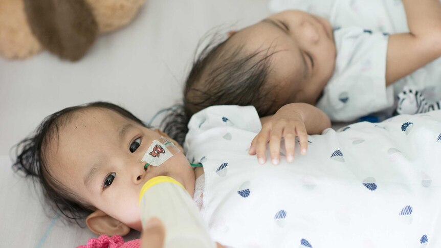 Formerly conjoined twins Nima and Dawa lie beside each other.