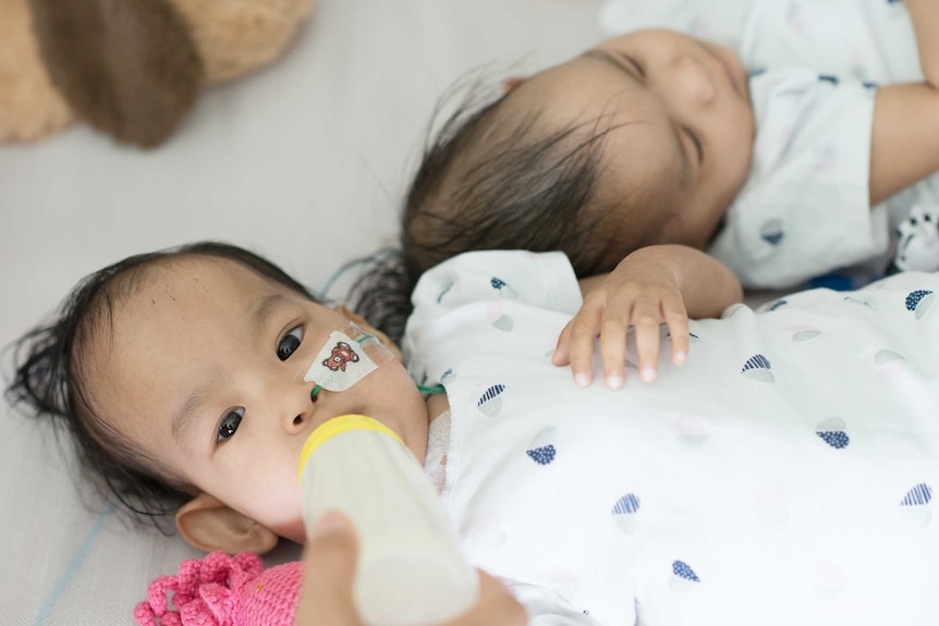 Formerly conjoined twins Nima and Dawa lie beside each other.