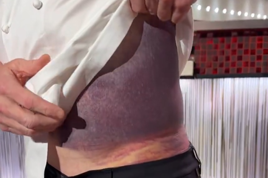 A person holding up their shirt to show a large purple bruise on the side of their torso.
