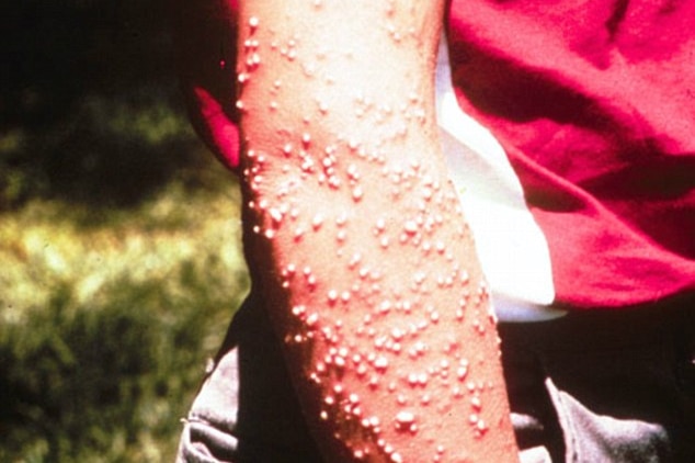 An arm with hundreds of red welts from a fire ant bite.