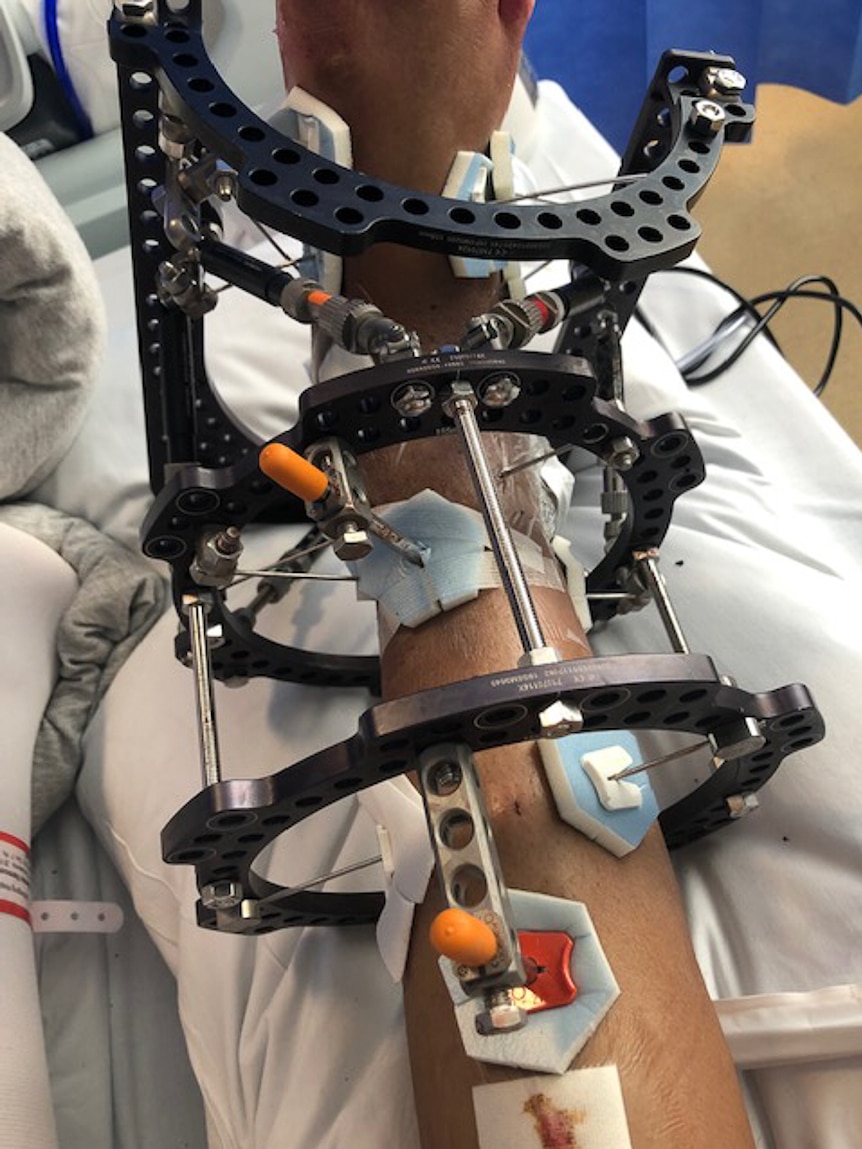 A young woman's leg is held together with steel rods and clamps in a hospital bed.