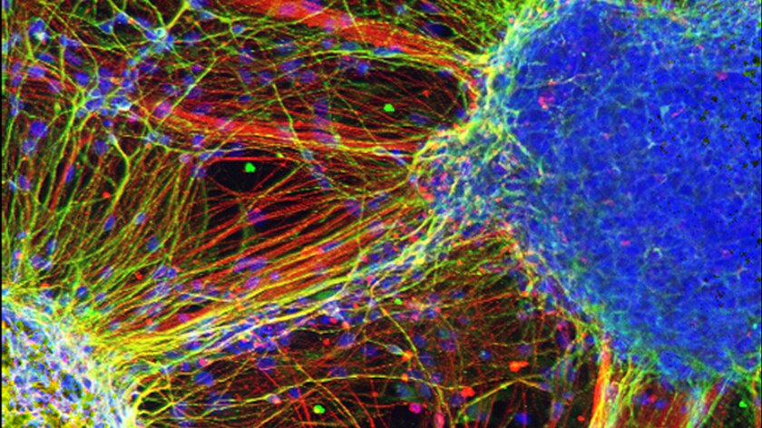 Neurons derived from schizophrenic patients