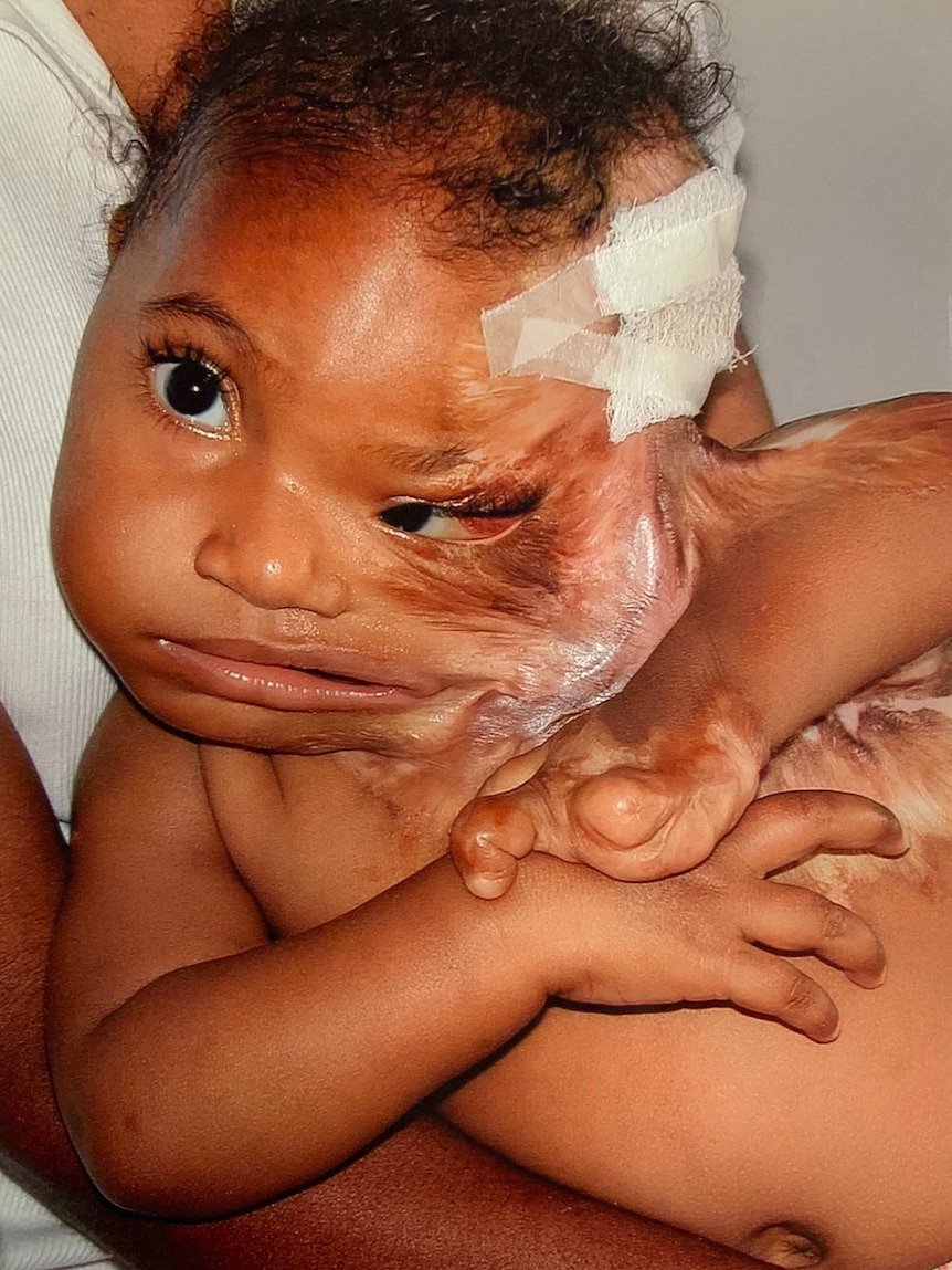 A small child with bandages on her head. Burns make her skin look waxy and have joined her neck to her shoulder.