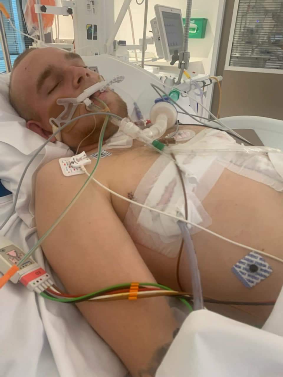 A man in a hospital bed with tubes and sensors on him