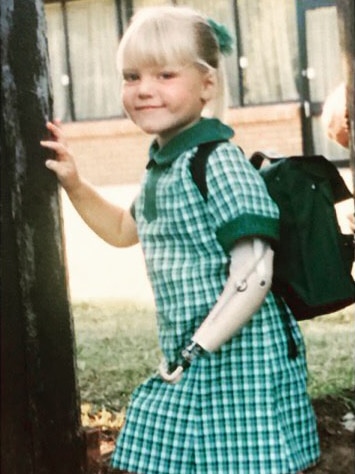 Jessica Smith wearing her prosthetic arm as a child.