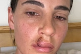 Asha Haegel with a fat lip after she needed six stitches and a tetanus needle following the dog attack.