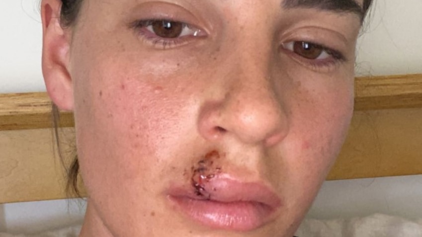 Asha Haegel with a fat lip after she needed six stitches and a tetanus needle following the dog attack.
