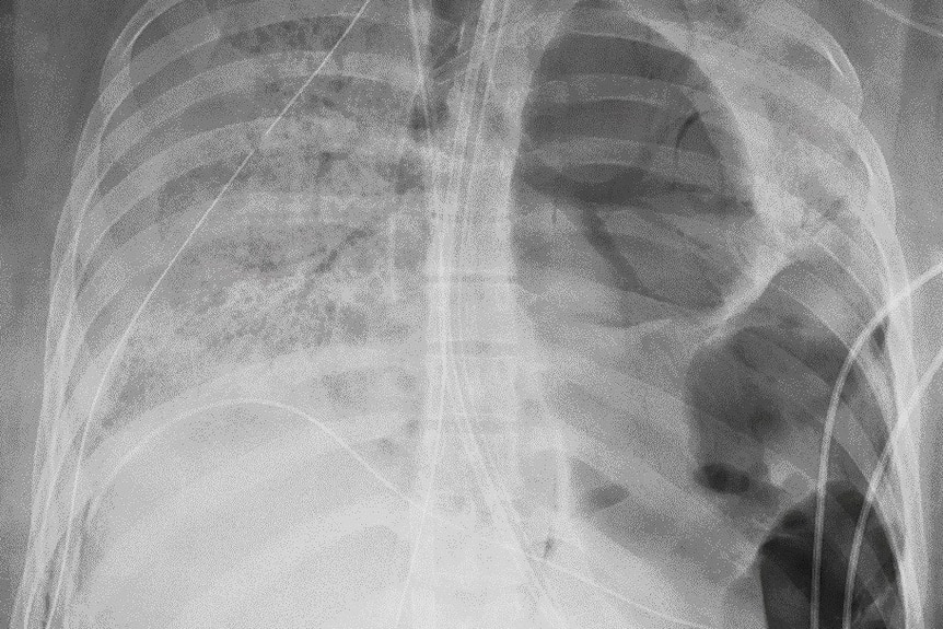 Xray of badly damaged lungs