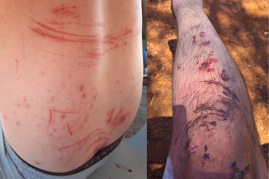 Scratches on a man's back and legs that were applied during the rescue.