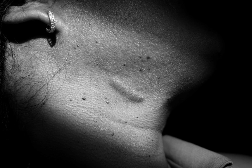 A woman displays her scars from domestic violence.