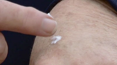 A cream that treats certain types of skin cancer has been for general use across Australia.