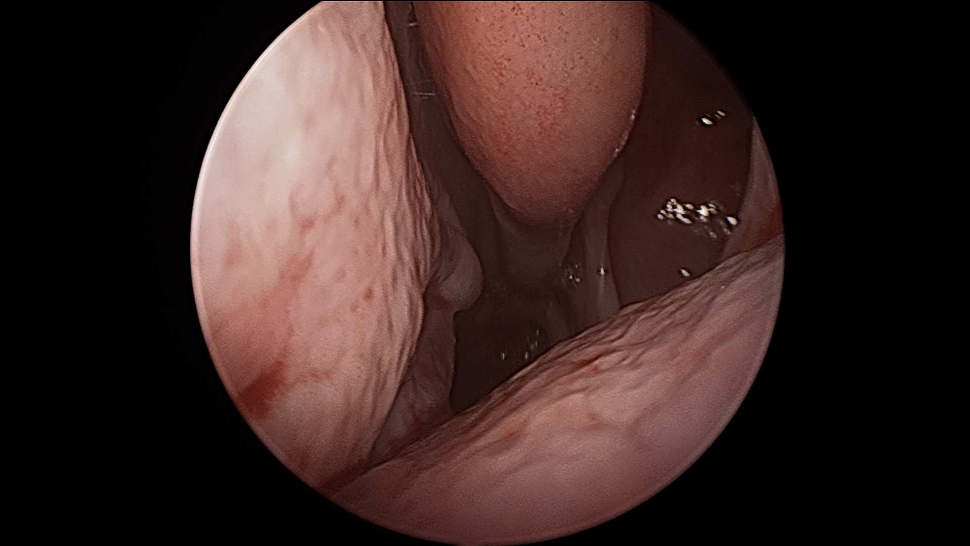 The inside of a nose looking full.