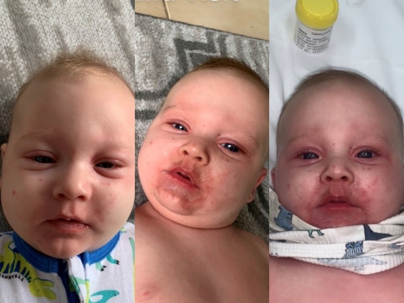 Three photo show the progression of baby Jarrod's illness. He gets more pale and has a red rash around his mouth.