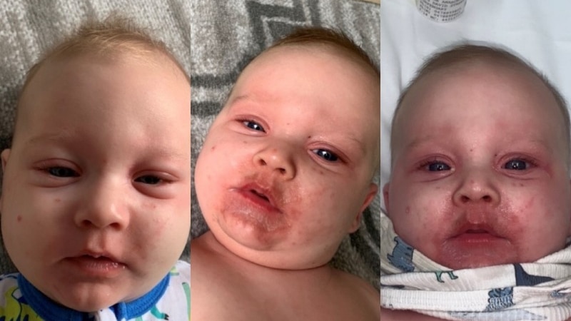 Three photo show the progression of baby Jarrod's illness. He gets more pale and has a red rash around his mouth.