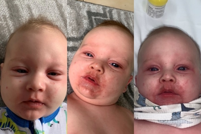 Three photo show the progression of baby Jarrod's illness. He gets more pale and has a red rash around his mouth.
