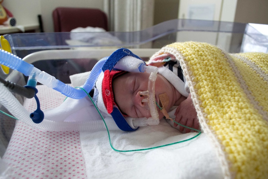 A tiny baby linked up to tubes on an assisted breathing machine.