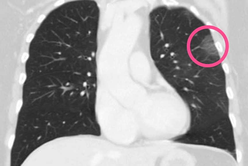 A chest CT scan with COVID-19 pneumonia marked.