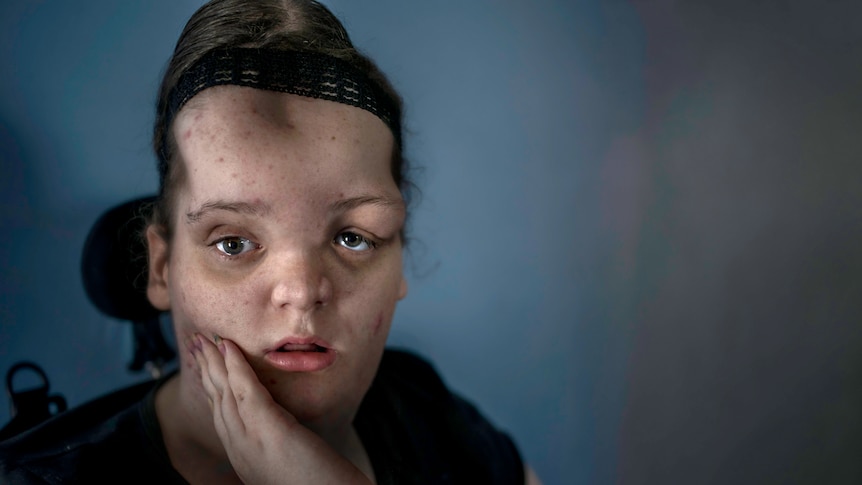 A teenage girl with Proteus syndrome