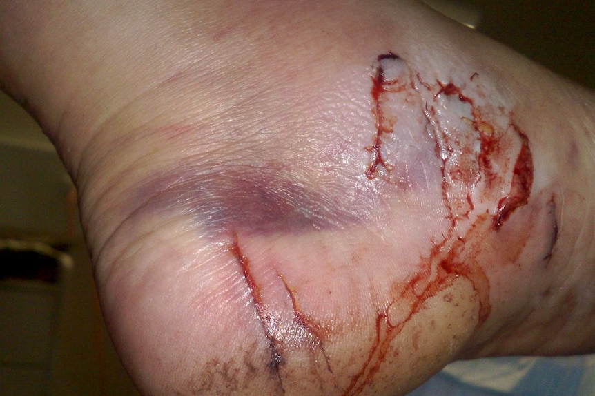 Croc attack victim Jane Dennis's foot