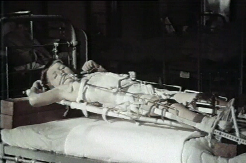 A boy is suspended above his bed while being treated for polio.