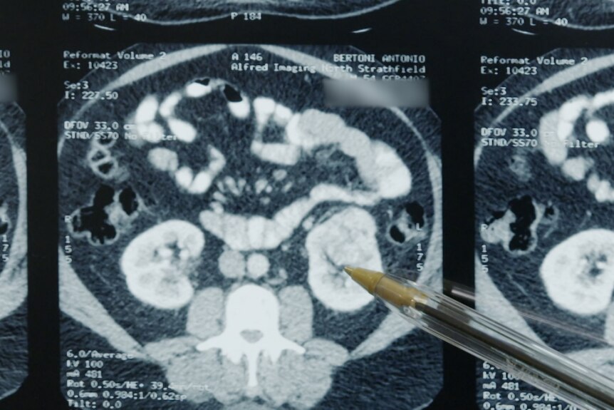 A man uses a pen to point at a tumour on an x-ray.