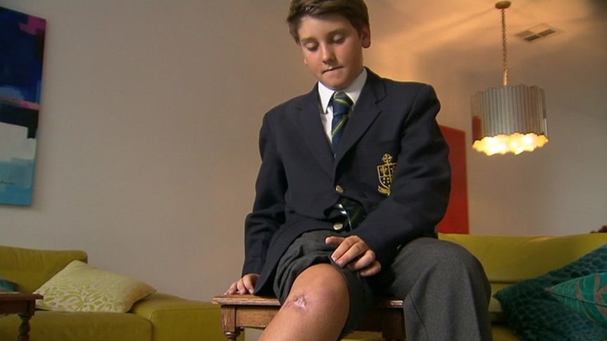 Gus Chrarles shows the healing ulcer on his leg.