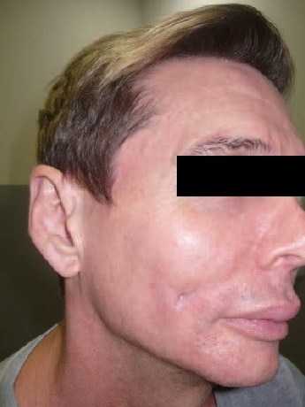 An unidentified patient with a chronic infection from cosmetic filler injections