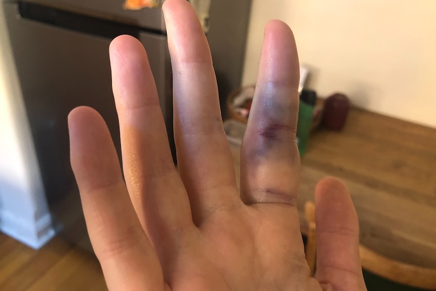 The writer's right hand turned towards the camera; the pointer finger is very bruised and swollen.