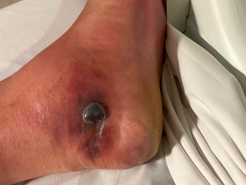 A foot with a dark purple sore spreading across the heel. The middle of the sore is raised.