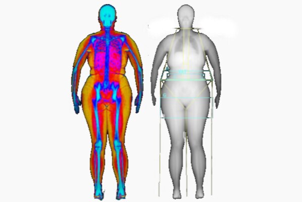A Dexa scan shows the bmi of a woman with PCOS