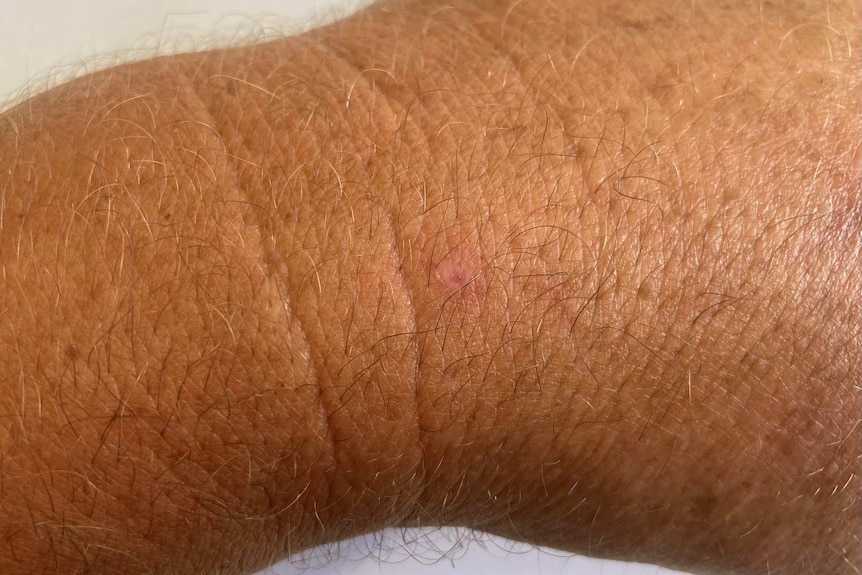 A man's wrist nearly completely healed.