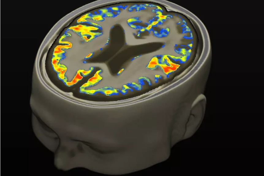 A colourful brain scan shows higher levels of iron highlighted in red.