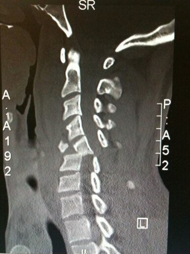 An x-ray shows shattered vertebrae and a severed spinal cord.