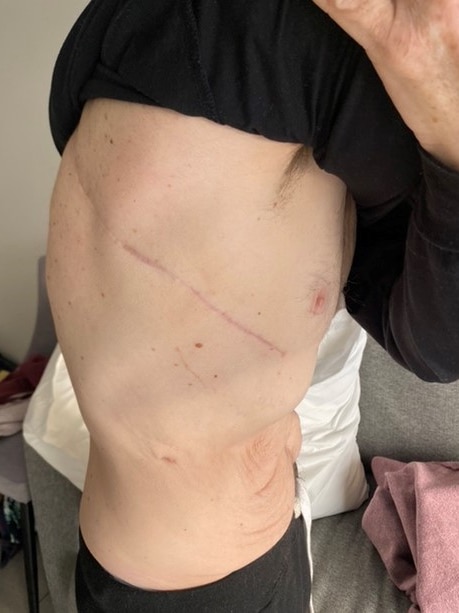 A scar on Stephen's side.