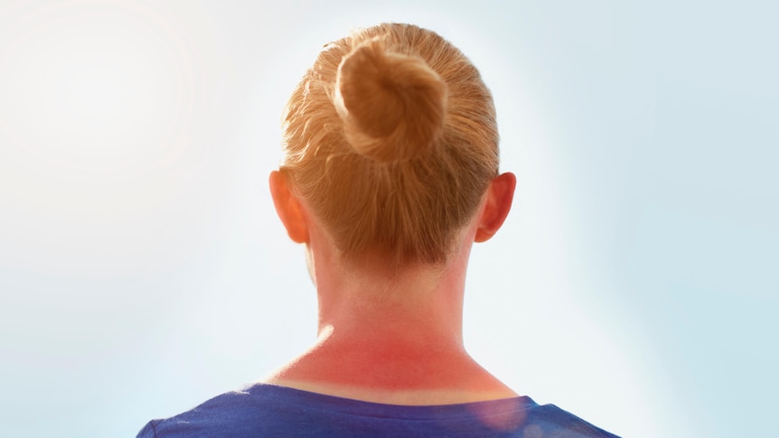 The back of a woman's neck showing a line of sunburn.