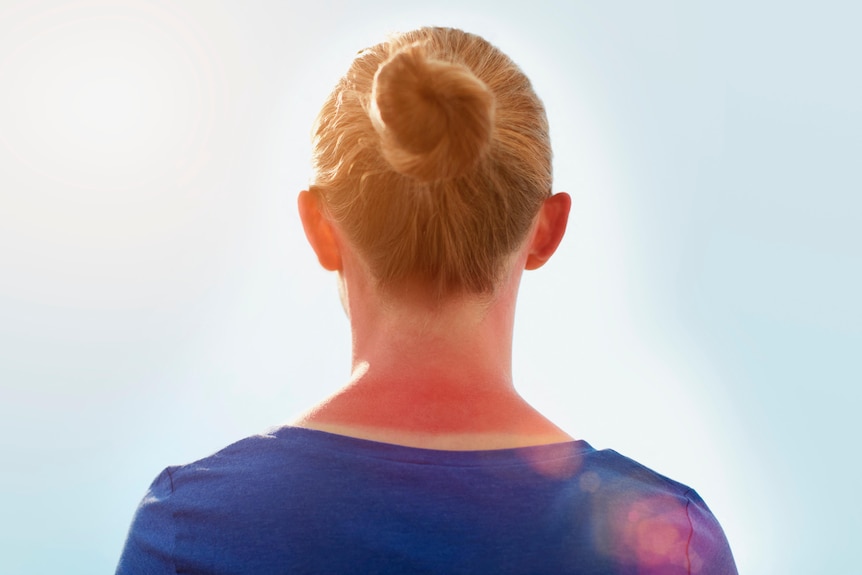 The back of a woman's neck showing a line of sunburn.