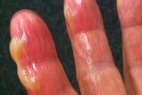 Shane Warne's hand after he burned it on a BBQ.
