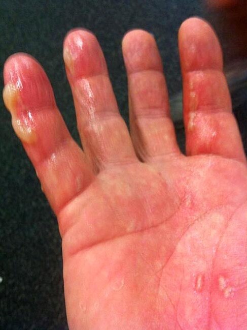 Shane Warne's hand after he burned it on a BBQ.