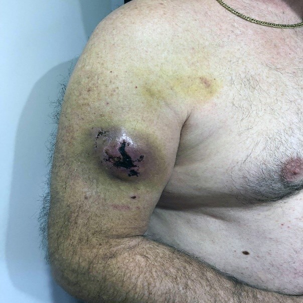 A man's bruised arm with a large bump and cut.
