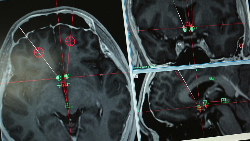 A brain scan of a methamphetamine addict undergoing experimental surgery in China.