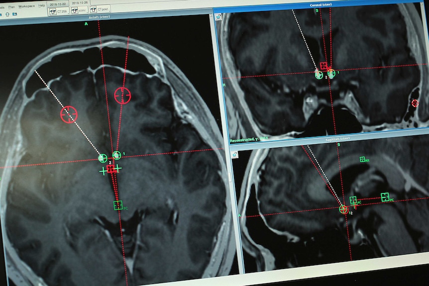 A brain scan of a methamphetamine addict undergoing experimental surgery in China.
