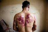 A Syrian man shows marks of torture on his back.
