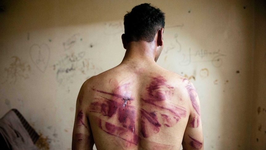 A Syrian man shows marks of torture on his back.